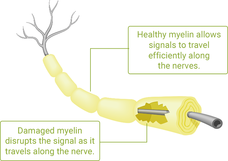 Neuron Image for CIDP